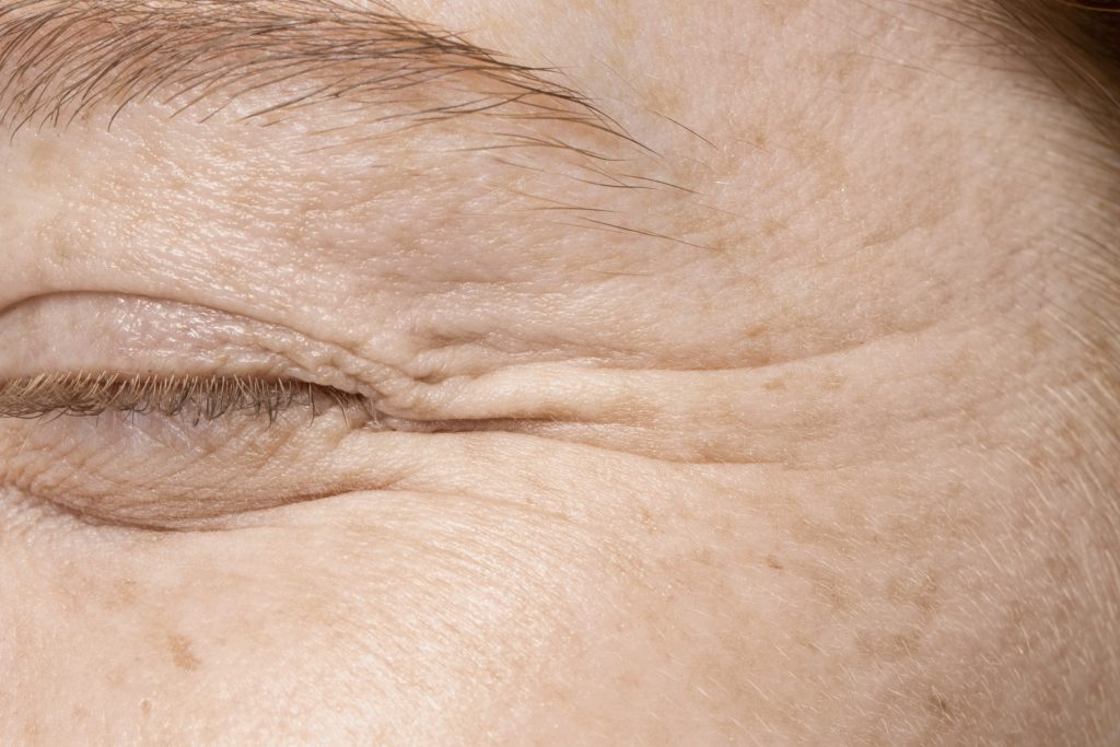 skinpen microneedling for wrinkles in Chicago IL