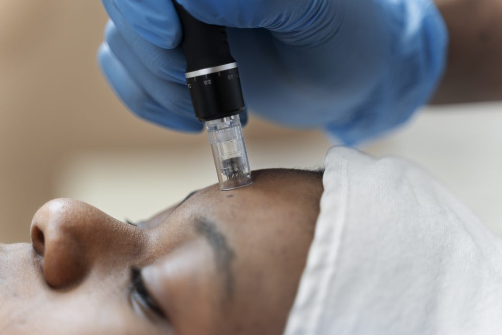 skinpen microneedling in Chicago IL